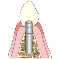 インプラント